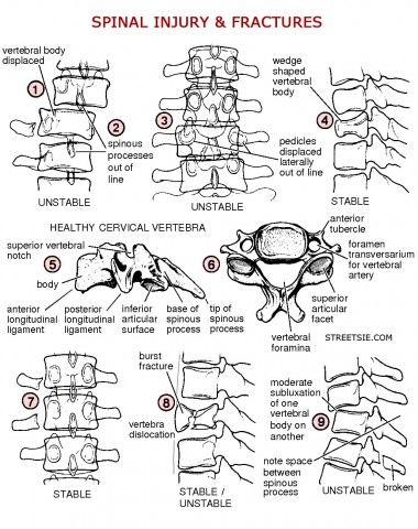 Spinal Injury Fracture and Dislocation